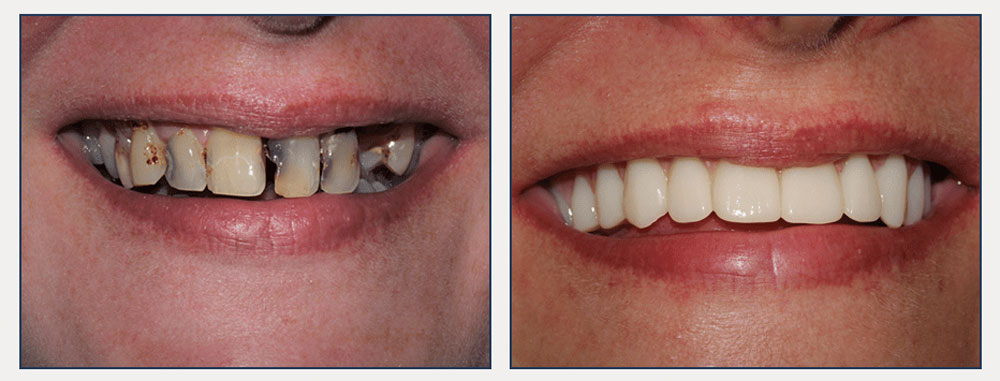 Dental Implants Before & After Smile Makeover Example