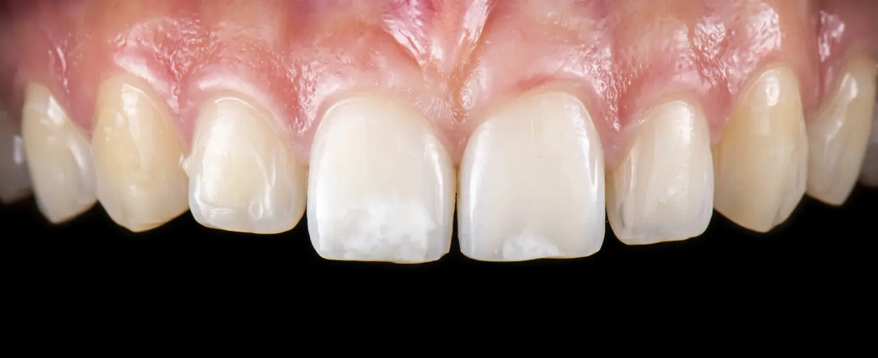 Porcelain Veneers Before Photo