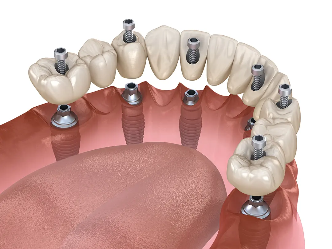 Dental Implant Graphic Showing Each Part
