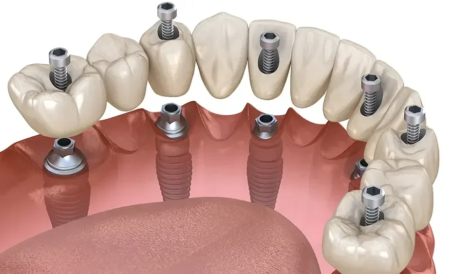 dental implant graphic showing each part