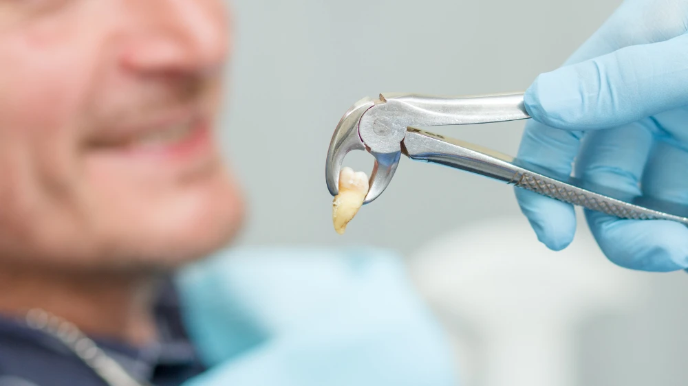 pain free tooth extraction