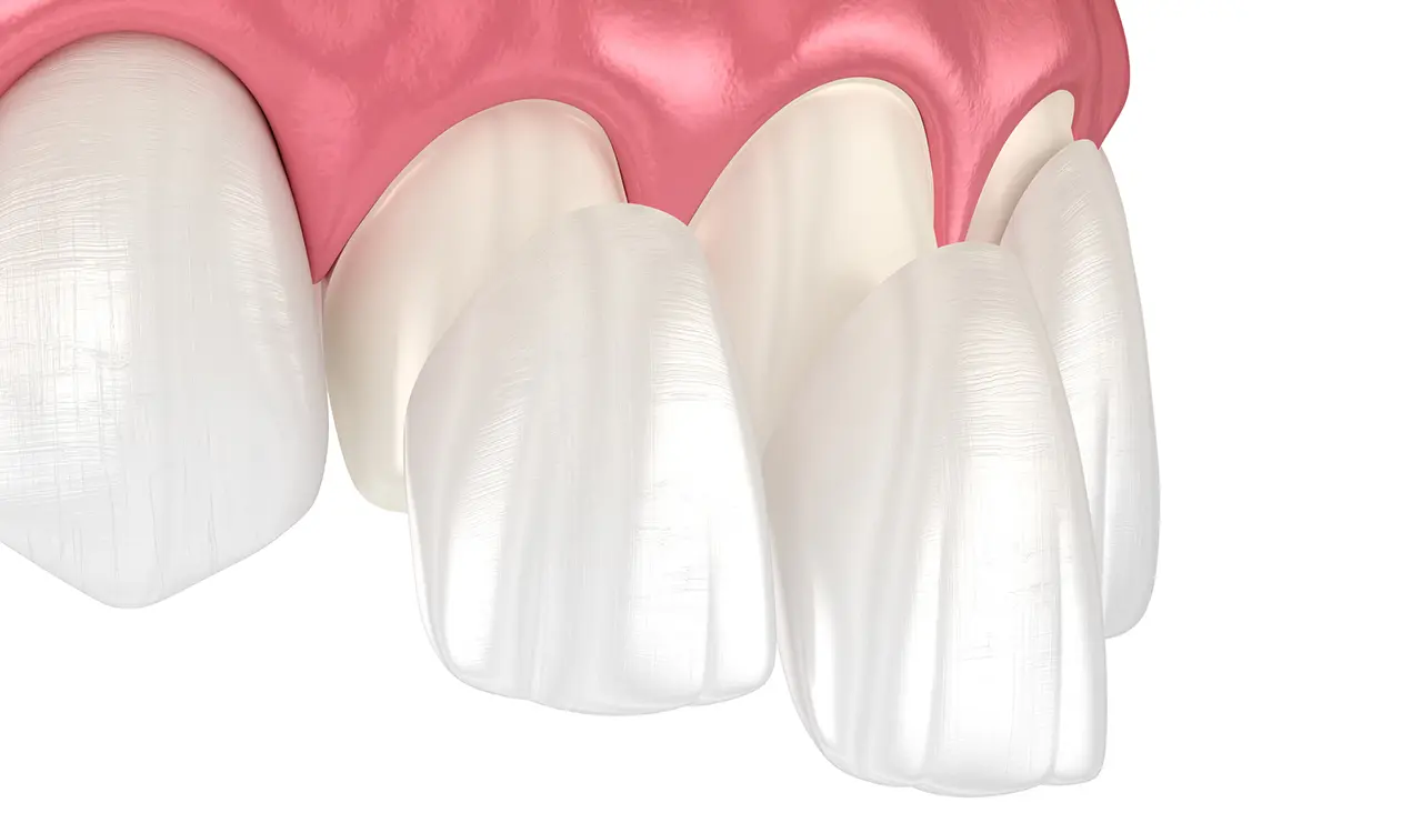 Porcelain Veneers Process Illustration