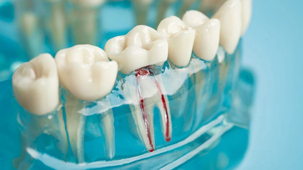 Root Canal Model