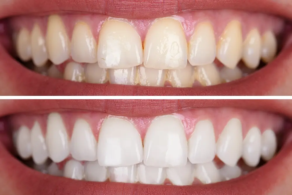 Professional Teeth Whitening Before And After