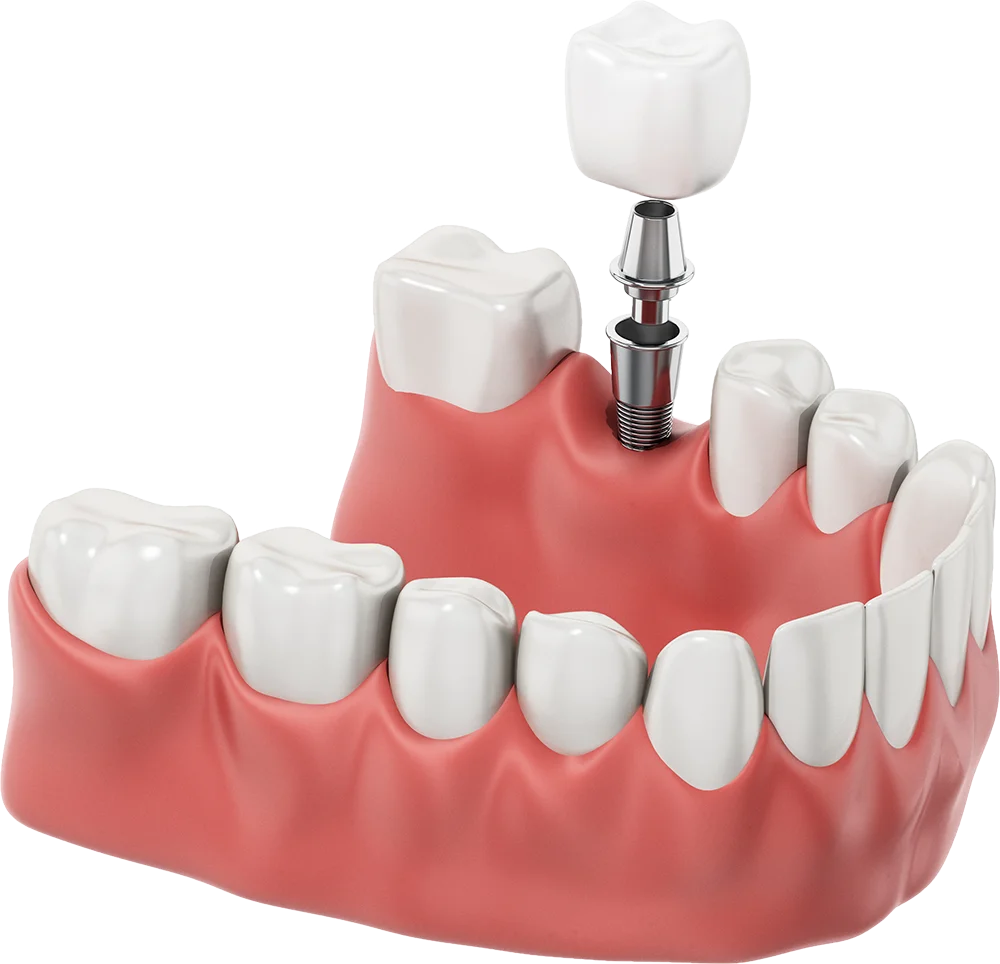 Dental Implant Illustration