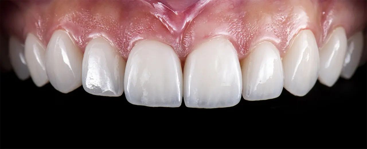 porcelain veneers after photo